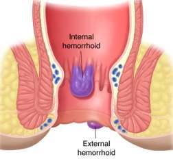 External hemorrhoid treatment remedy hemorrhoids