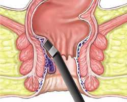 3 hemorrhoids treatment cryotherapy coagulation 4