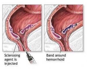Banding