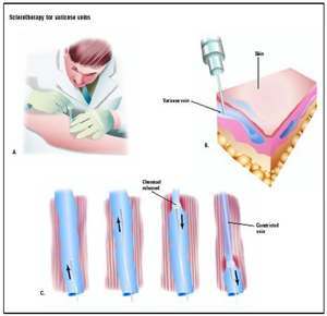 Hemorroida Imagens on For Hemorrhoids Complications To Sclerotherapy As A Hemorrhoid